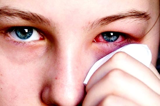 Trị bệnh đau mắt đỏ từ bài thuốc dân gian