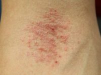 Lưu ý mà người bệnh eczema cần phải tránh