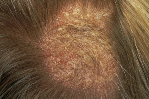 Tóc rụng nhiều là bệnh gì? Dấu hiệu của bệnh lý nguy hiểm