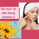 Da mụn có nên dùng vitamin C không?