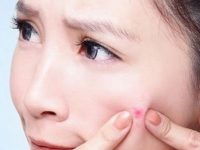 Cách trị mụn nhọt từ nguyên liệu thiên nhiên