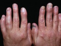 Cảnh báo về viêm khớp ngón tay và cách điều trị hiệu quả